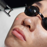 Carbon Laser Facial