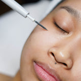 Seborrheic Keratosis Removal