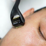 Microneedling