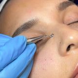 Milia Removal