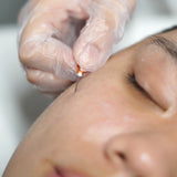Subcision